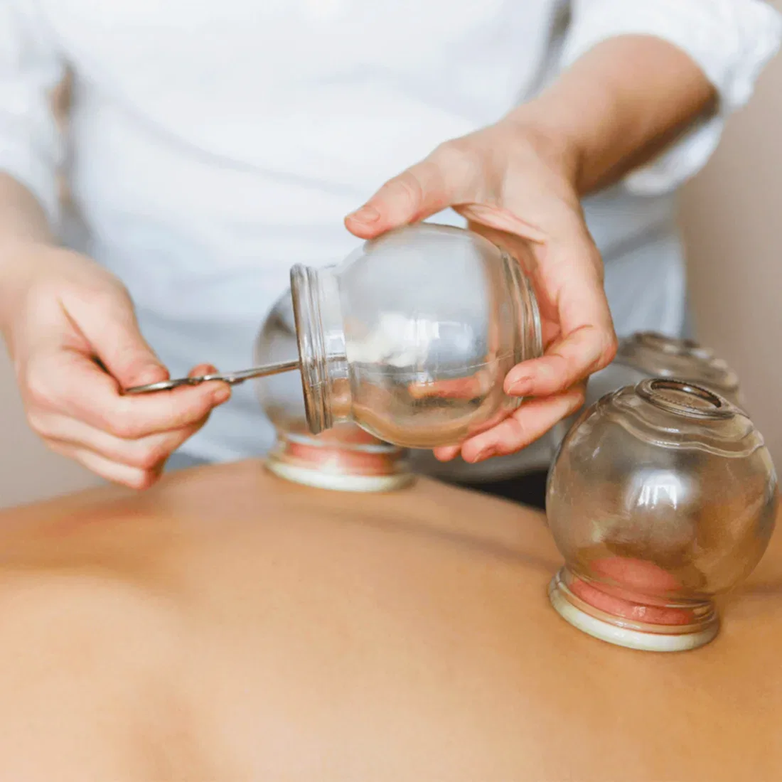 Baguan ( Ateşli Kupa ) Terapi